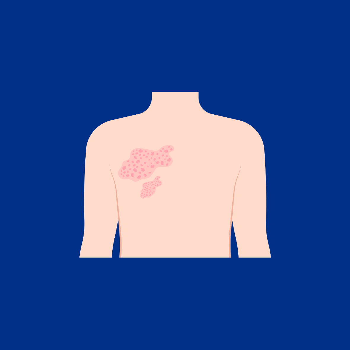 Image of Upper Body With Shingles Rash