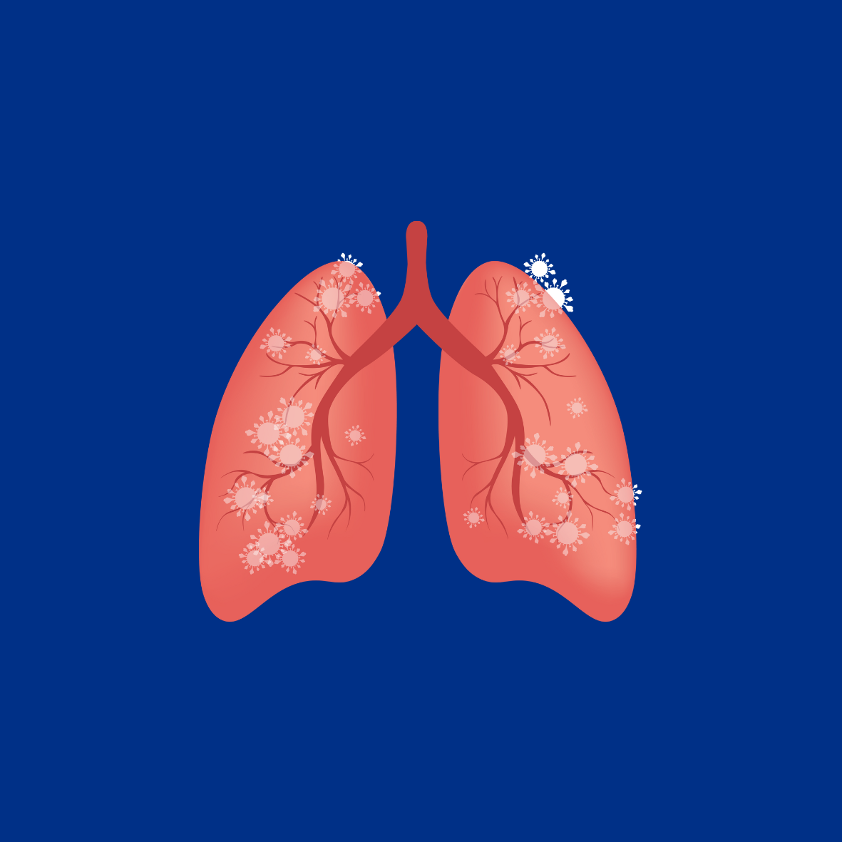 Image of Lungs Infected with Pneumonia